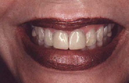 Darkly stained teeth with aging dental restorations