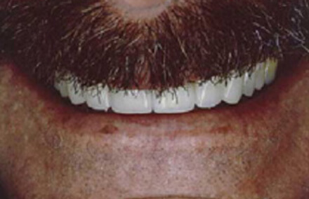 Man's smile corrected with veneers and crown