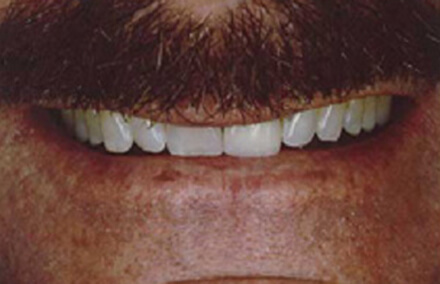 Man's smile with worn and crooked teeth