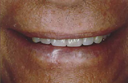 Flawless smile enhanced by natural looking veneers