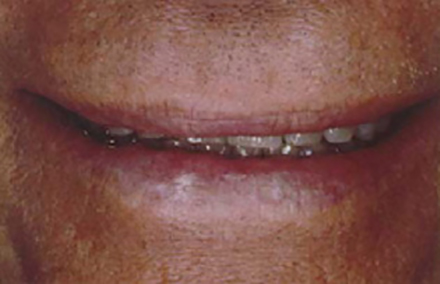 Man's smile with short worn teeth concealed