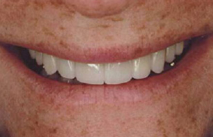 Gorgeous white smile with perfect spacing