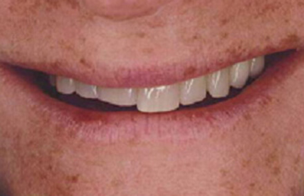 Smile with shorter left teeth