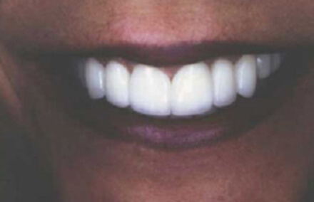 Woman's smile repaired with natural looking veneers