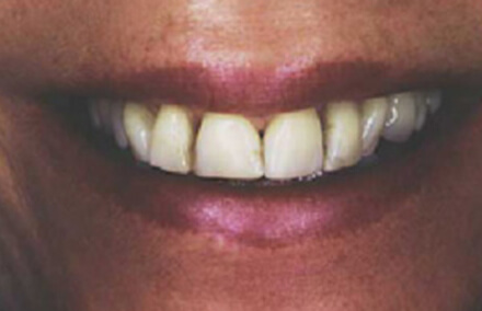 Woman with discolored and unnatural looking veneers
