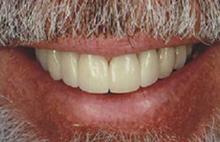 Man's smile beautiful repaired with Empress veneer-crowns