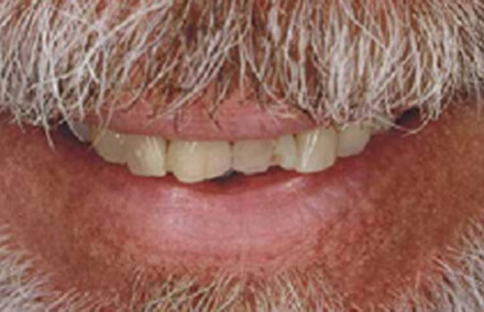 Worn smile with damaged crooked teeth