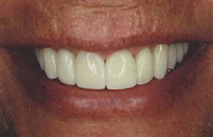 Teeth after empress crown and veneer smile makeover