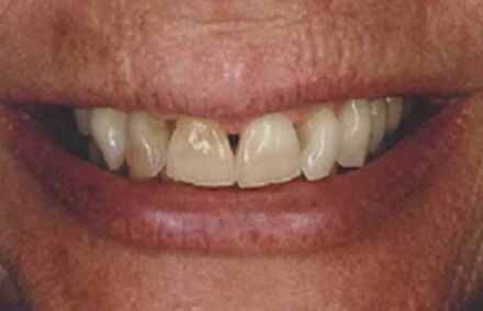 Worn and discolored smile with large gaps