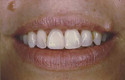 Beautiful woman's smile with Empress veneers