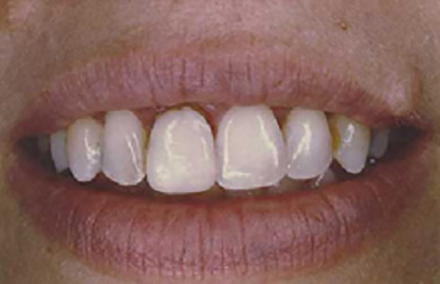 Woman with broken porcelain veneer on left tooth